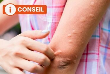 Piqûre de moustique : traitement et conseils 
