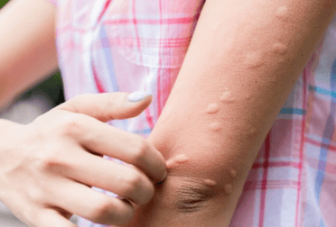Piqûre de moustique : traitement et conseils 